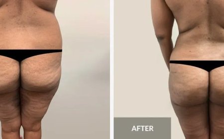 Cosmetische chirurgie in Suriname – Taboe of trend