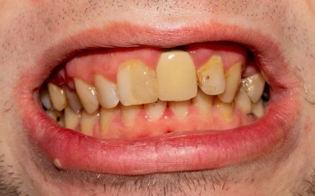 Britse landmacht wijst rekruten af wegens slechte tanden