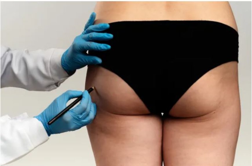 Strengere regels voor Braziliaanse bilcorrecties: einde aan ‘Wilde Westen’ in cosmetica-indus