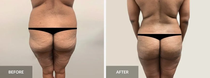 Cosmetische chirurgie in Suriname – Taboe of trend