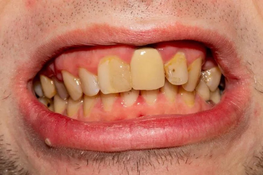 Britse landmacht wijst rekruten af wegens slechte tanden