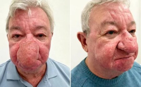 Man met zeldzame neusgroei krijgt nieuw leven na operatie