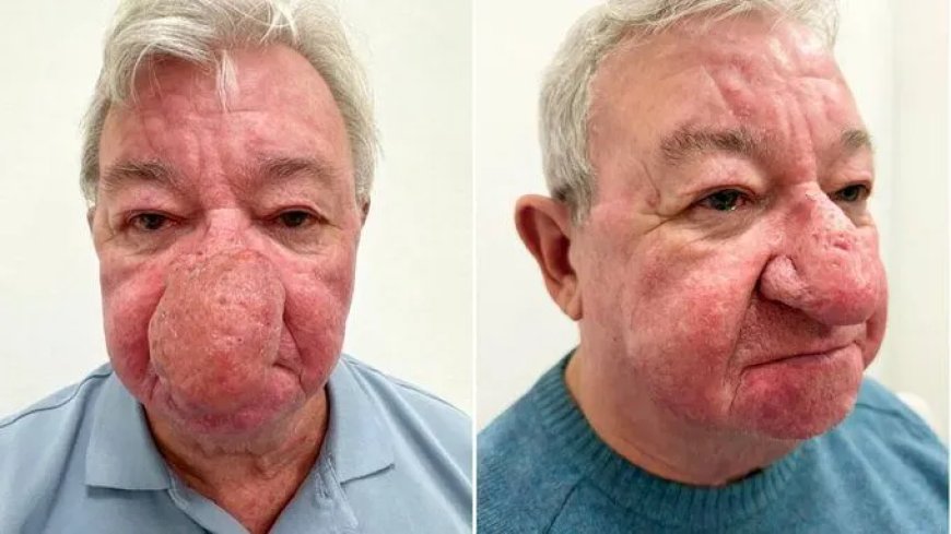 Man met zeldzame neusgroei krijgt nieuw leven na operatie