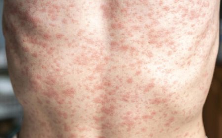 De Amerika’s verliezen mazelenvrije status: Paho roept op tot gezamenlijke actie