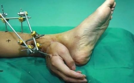 WIST U DAT: Hand van Chinese fabrieksarbeider tijdelijk aan enkel is vastgezet om amputatie t