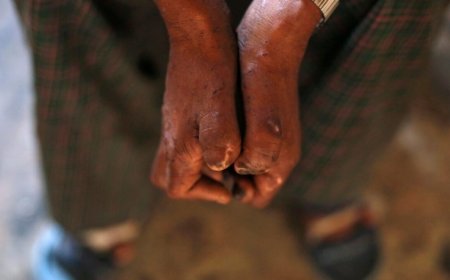 Dienst Dermatologie: geen reden voor angst, wel voor alertheid bij lepra