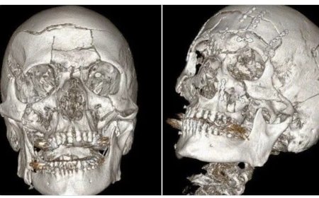 Russische chirurgen reconstrueren gezicht na zware sneeuwscooterbotsing