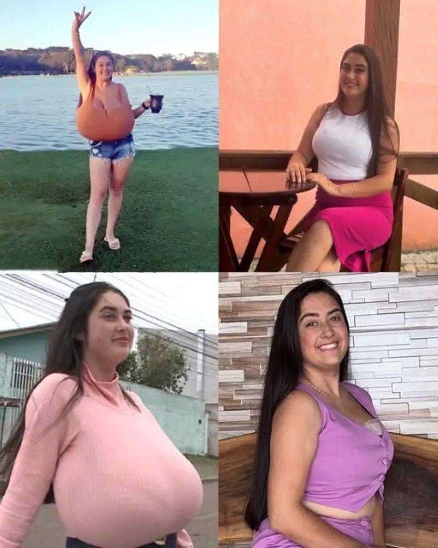 WIST U DAT: Een 21-jarige Braziliaanse tien kilo van haar borsten liet verwijderen?