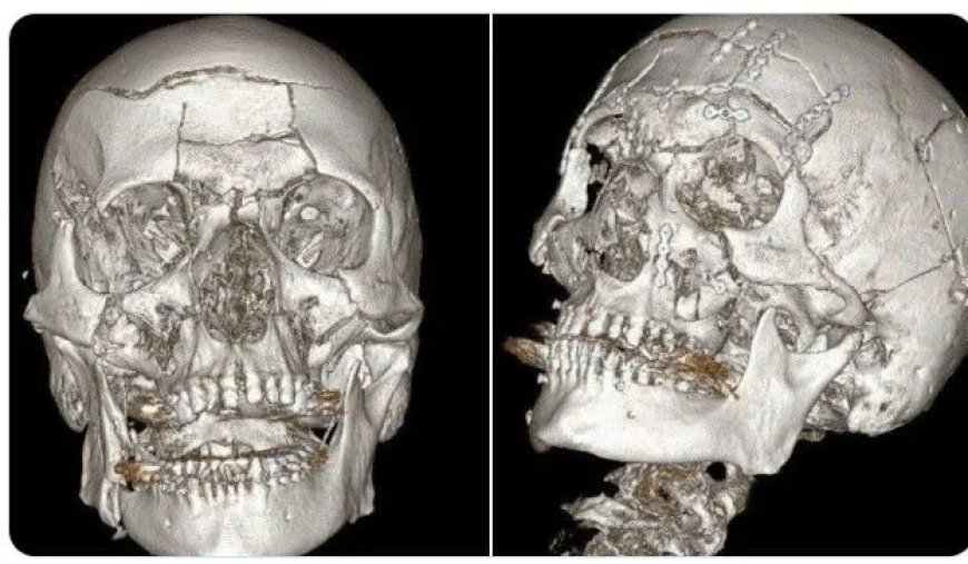 Russische chirurgen reconstrueren gezicht na zware sneeuwscooterbotsing