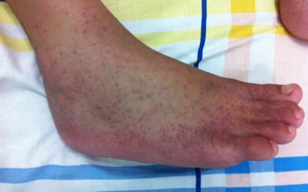 Viroloog deelt persoonlijke chikungunya-ervaring als waarschuwing aan samenleving