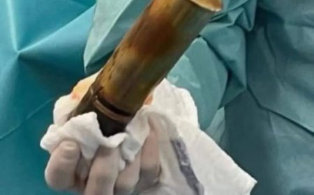 Opmerkelijk – Patiënt met anaal ingebrachte WO I-granaat zorgt voor paniek in Frans ziekenhui