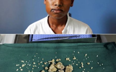 WIST U DAT: Bij een tiener in India 232 tanden uit zijn kaak werden verwijderd?