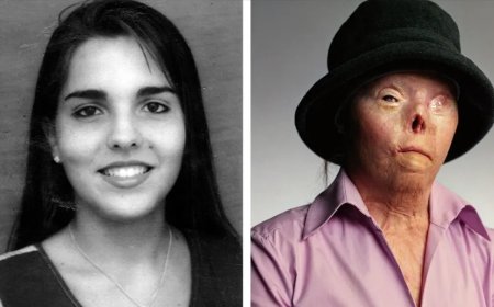 WIST U DAT: 20-jarig verbrand slachtoffer drankrijder in VS stem werd in campagne tegen rijde