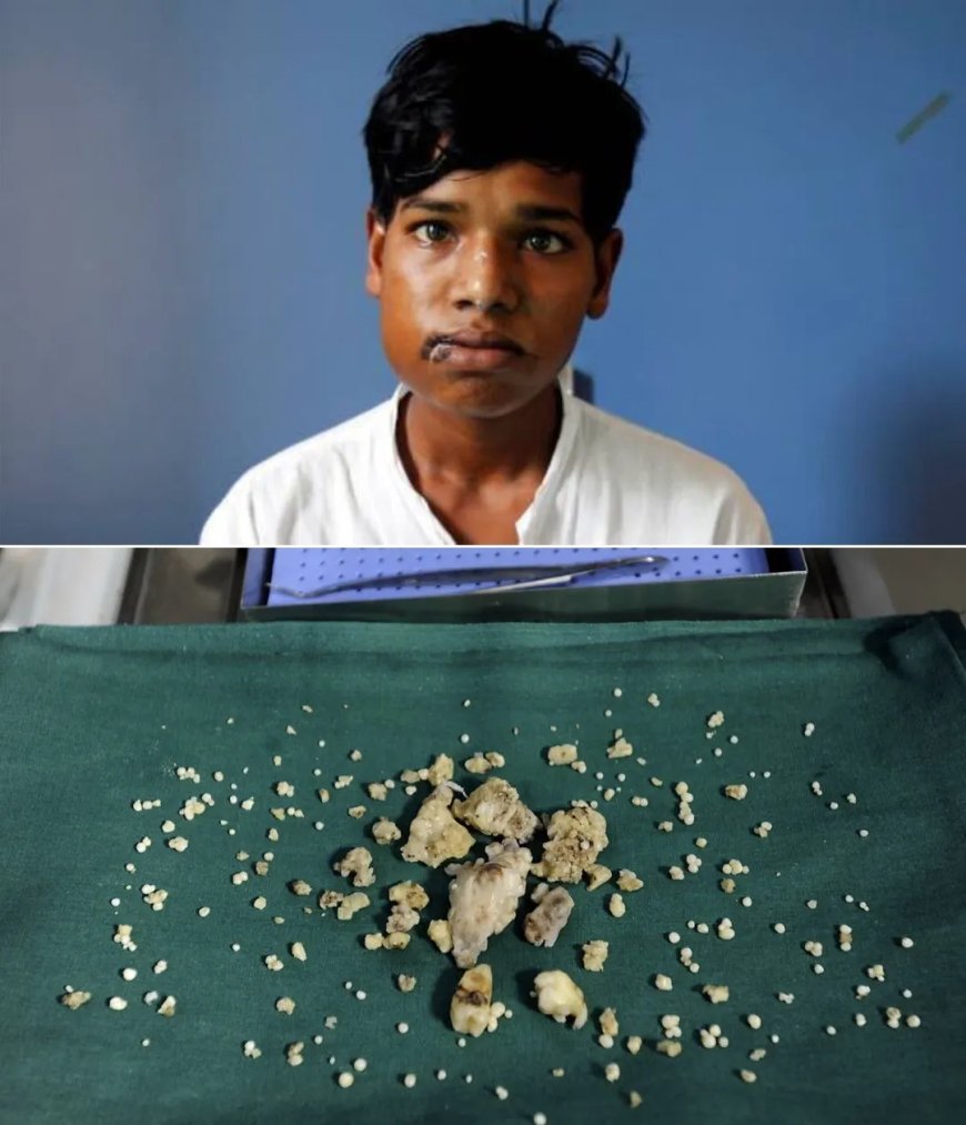 WIST U DAT: Bij een tiener in India 232 tanden uit zijn kaak werden verwijderd?