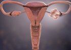 Hormonale aandoening die miljoenen vrouwen treft krijgt nieuwe naam