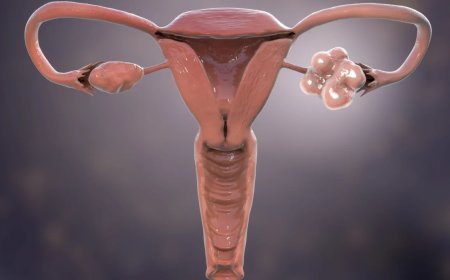 Hormonale aandoening die miljoenen vrouwen treft krijgt nieuwe naam