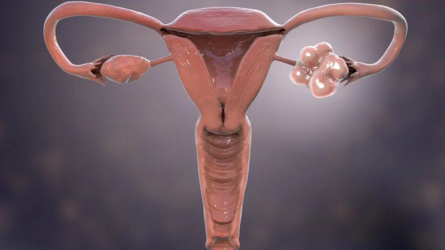 Hormonale aandoening die miljoenen vrouwen treft krijgt nieuwe naam