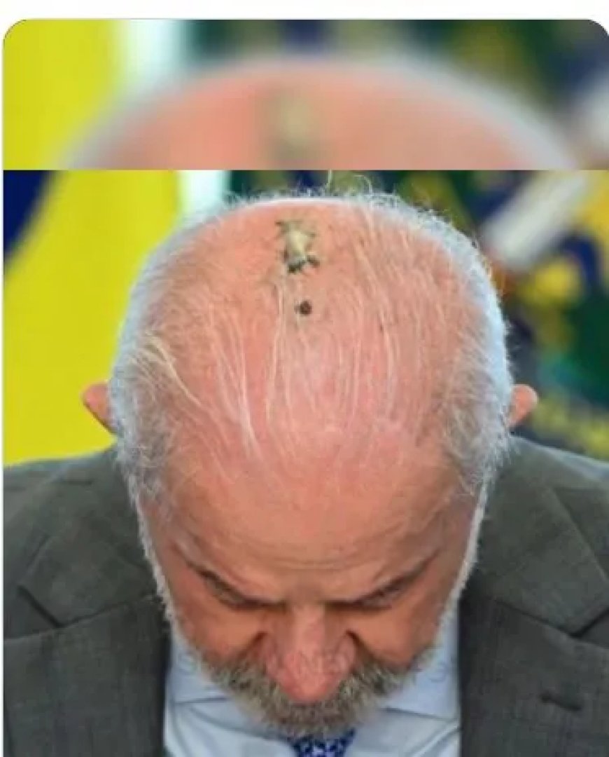 Lula ondergaat bestraling na operatie wegens huidkanker