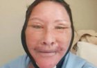 Opmerkelijk – Ierse vrouw ging naar Istanbul voor facelift, maar trollen zeggen dat het in ee