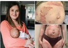 Zeldzame zwangerschapsziekte maakt moeder allergisch voor eigen baby