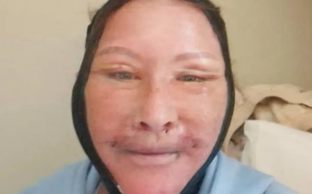 Opmerkelijk – Ierse vrouw ging naar Istanbul voor facelift, maar trollen zeggen dat het in ee