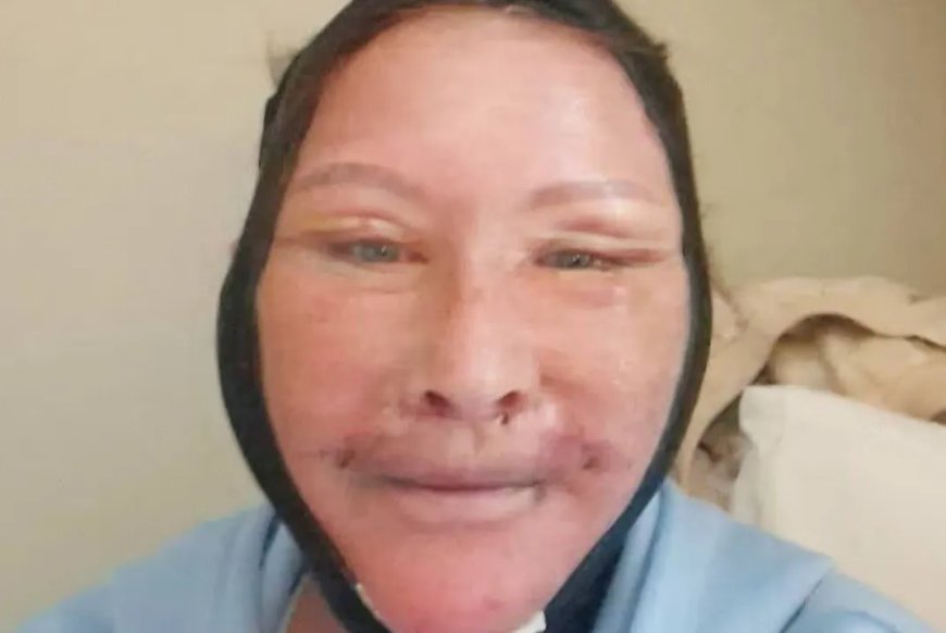 Opmerkelijk – Ierse vrouw ging naar Istanbul voor facelift, maar trollen zeggen dat het in ee