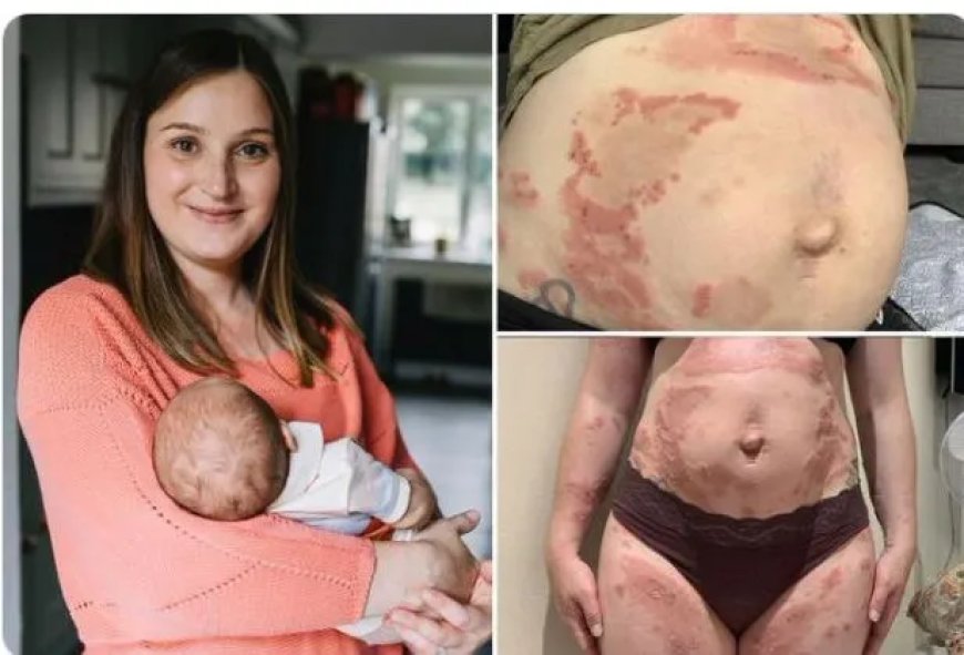 Zeldzame zwangerschapsziekte maakt moeder allergisch voor eigen baby