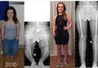 Vrouw wordt 33 centimeter langer door operaties