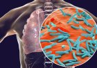 Onderzoek wijst op tekortkomingen in bestrijding tuberculose