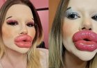 WIST U DAT: Bulgaarse jonge vrouw wordt gemeden vanwege haar extreme lippen?