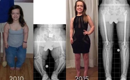 Vrouw wordt 33 centimeter langer door operaties