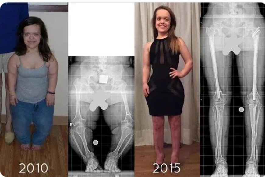 Vrouw wordt 33 centimeter langer door operaties
