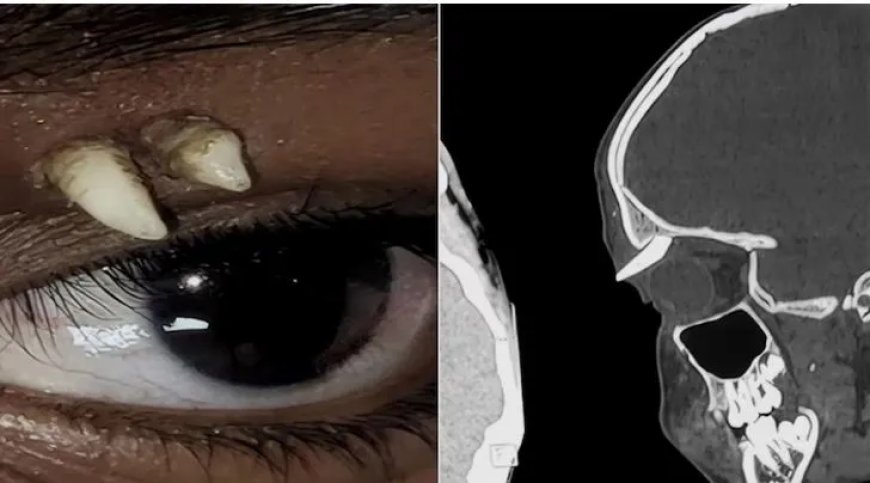 Artsen vinden tand boven het oog van jongen