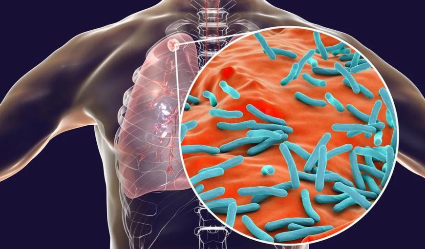 Personeelstekort belemmert bestrijding van tuberculose